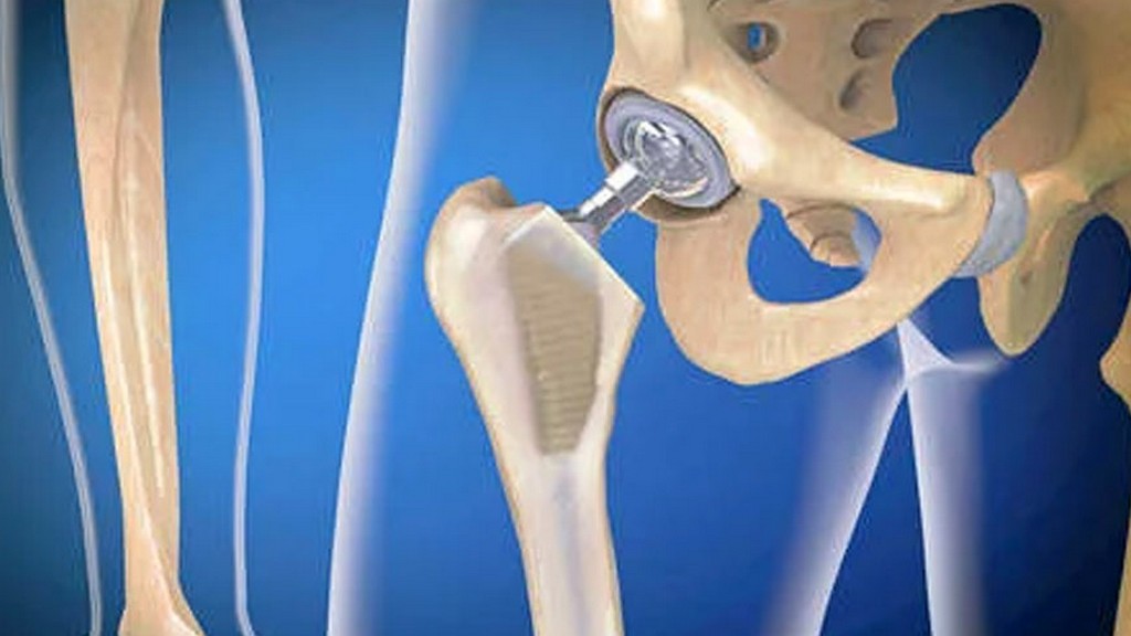 ASTM F2028-17 Glenoid Gevşemesi veya Ayrışmasının Dinamik Değerlendirmesi için Standart Test Yöntemleri