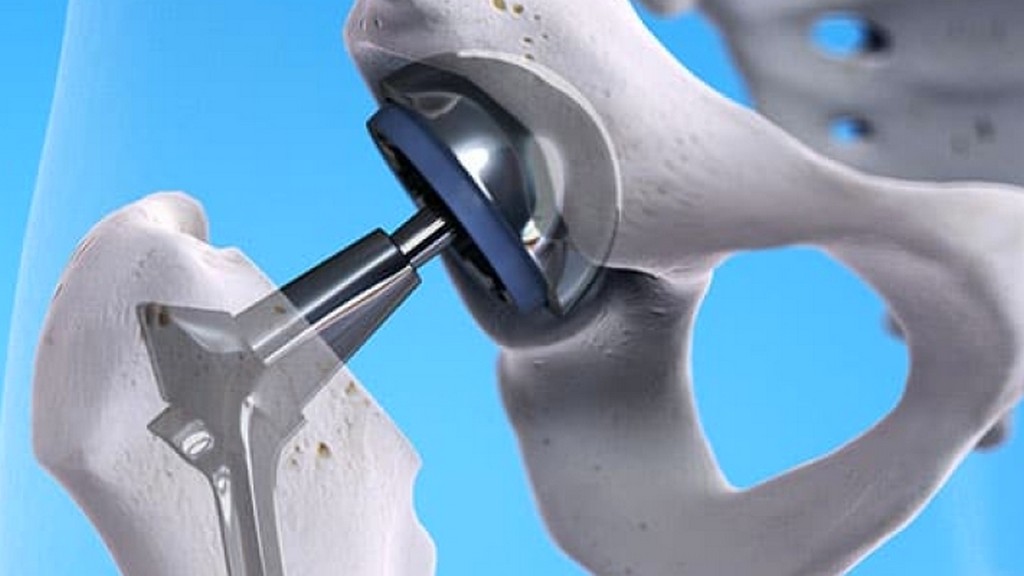 ASTM F2580-18 Proksimal Sabit Femoral Kalça Protezinin Modüler Bağlantısının Değerlendirilmesine Yönelik Standart Uygulama