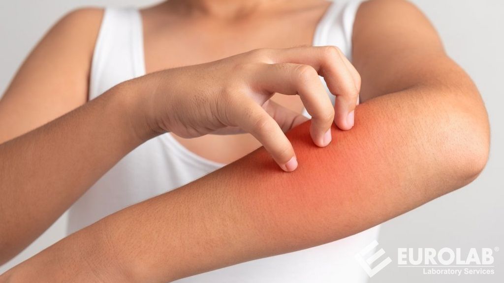 Derialtı Reaksiyon Testi (İrritasyon)