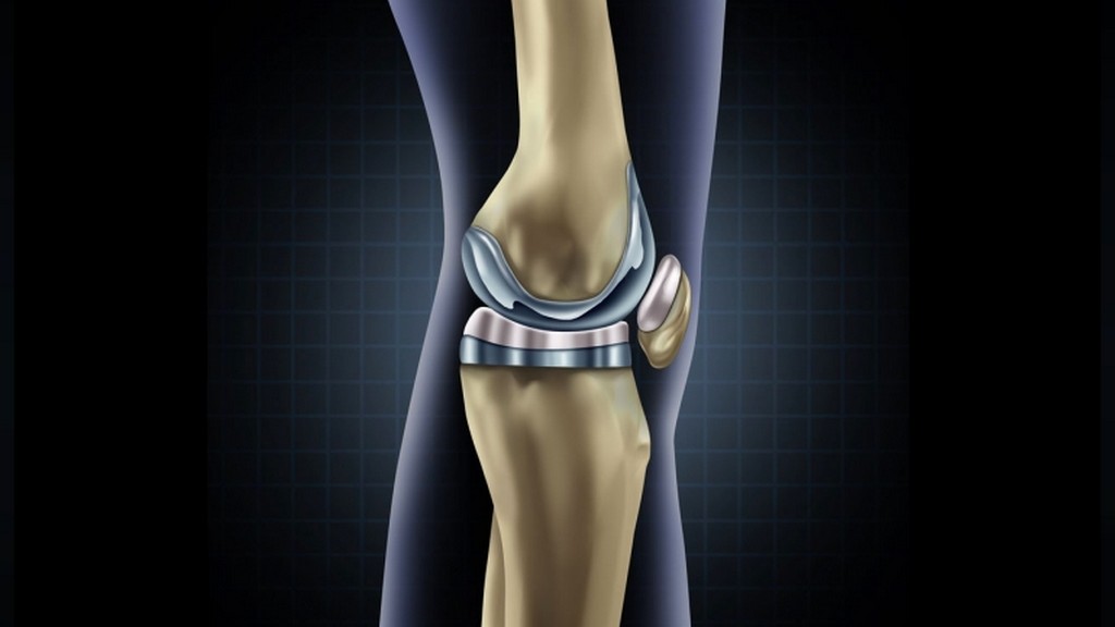 PI-53 Saplı Femoral Total Diz Artroplastisi (TKA) Bileşenlerinin Yorulma Testi